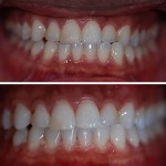 Teeth Whitening – Before & After 1