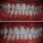 Teeth Whitening – Before & After Preview