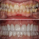 Full Mouth Rehabilitation Before & After