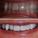 Teeth Whitening – Before & After 2