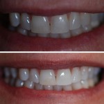 Teeth Whitening – Before & After 3