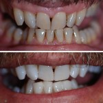 Teeth Whitening – Before & After 4